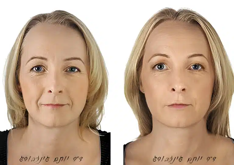 טיפול רדיאס תמונה לפני ואחרי