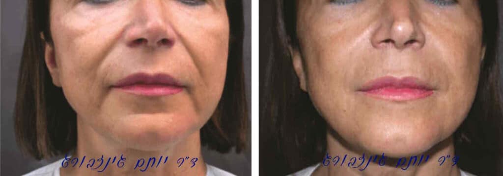 החלקת קמטי מריונטה בטיפול PRF פיסול פנים, קמטי מריונטה