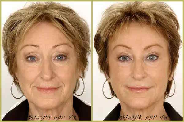 טיפול פנים עם רדיאס - לפני ואחרי