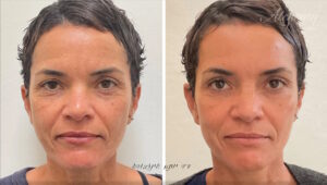 רדיאס, טיפול פנים עם רדיאס