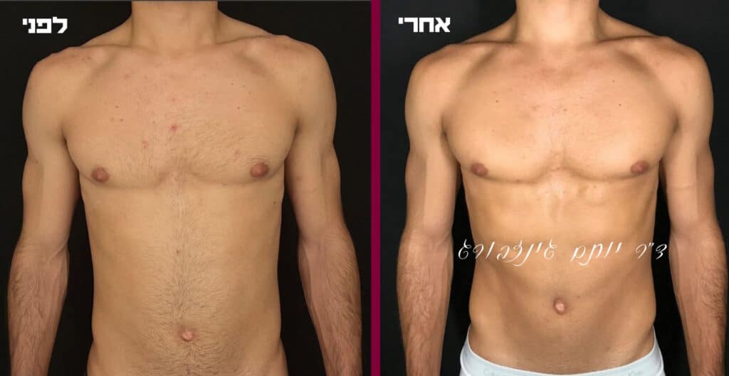 חזה גברי לפני ואחרי עיצוב באמצעות הזרקת חומצה היאלורונית