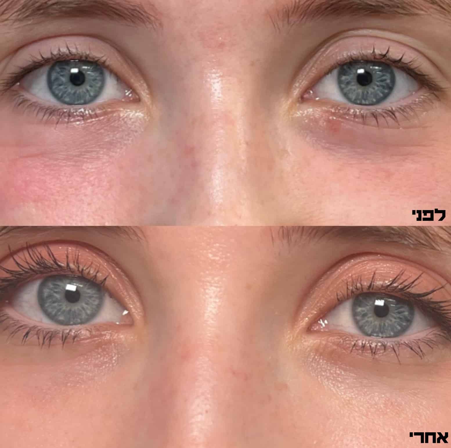 טיפול פולינוקלאוטידים מתחת לעיניים לפני ואחרי