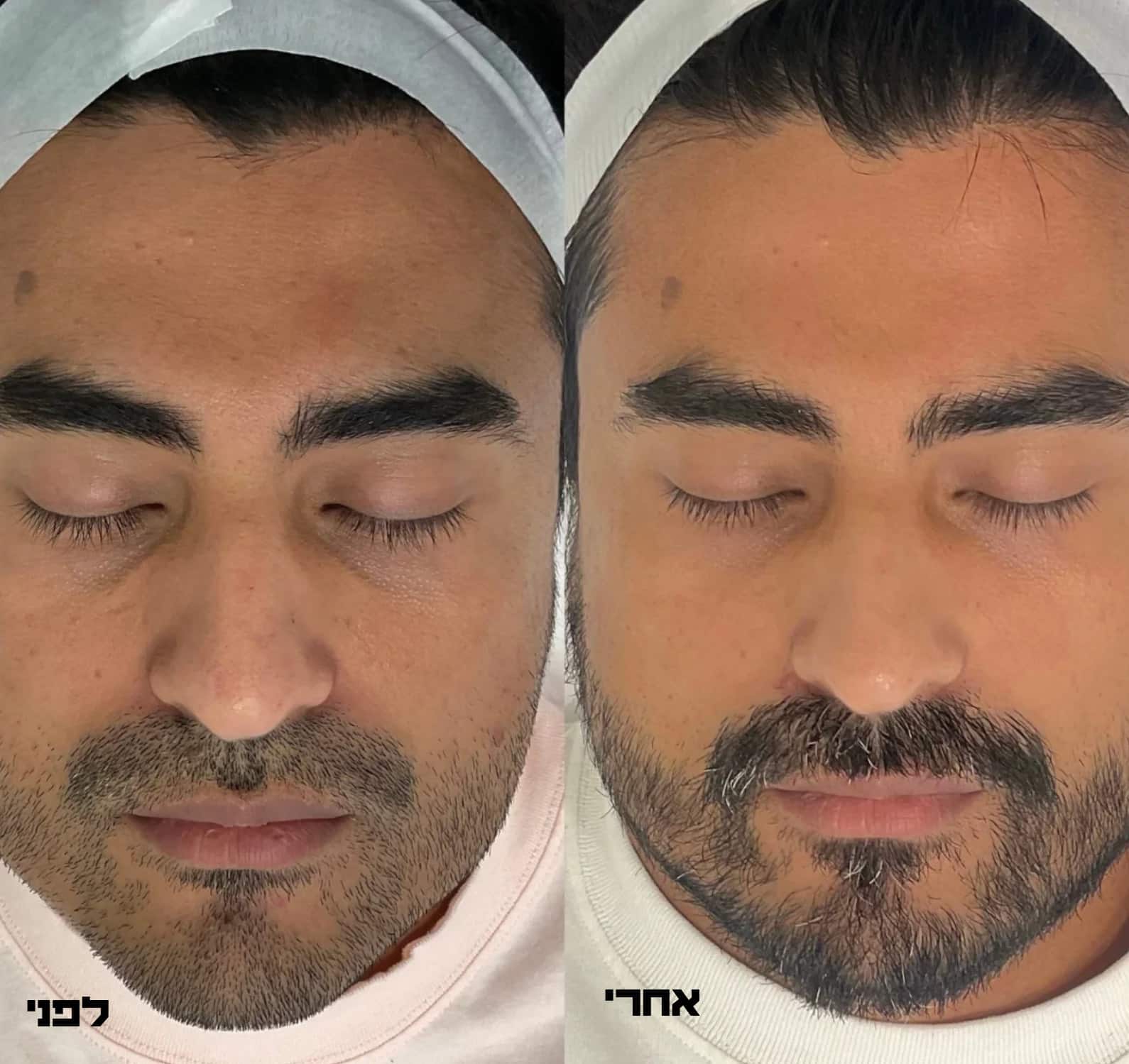 פולינוקלאוטידים להצערת הפנים והגוף לפני ואחרי