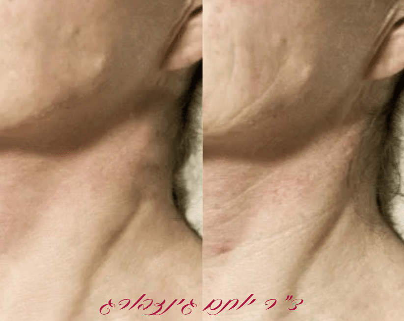 רדיאס מדולל