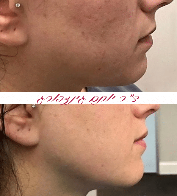 רדיאס לקו הלסת