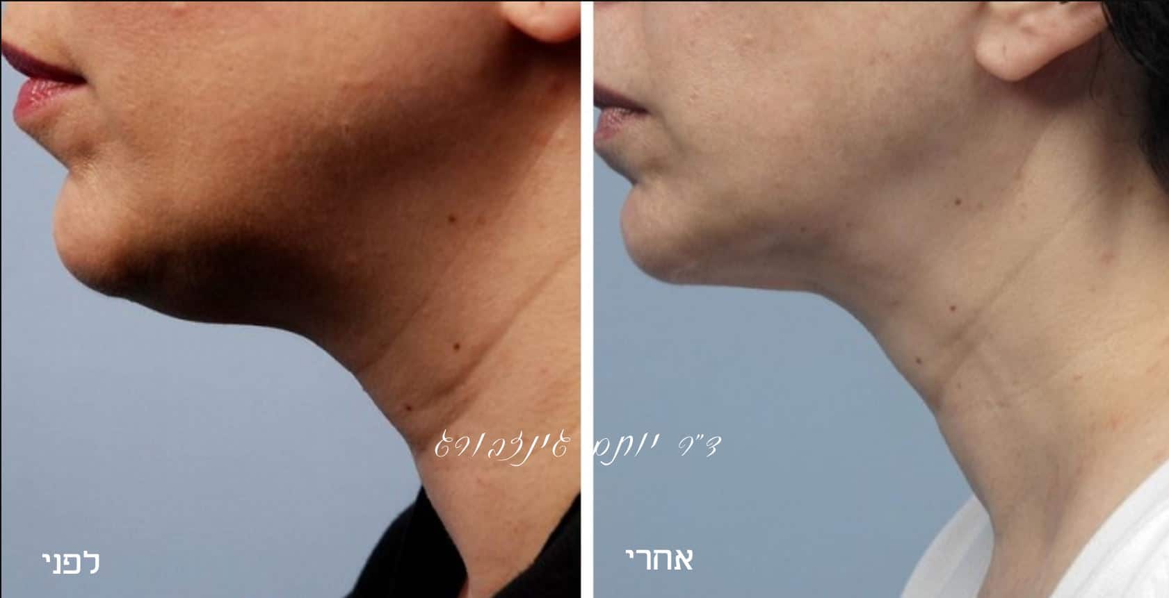 המסת שומן בסנטר לפני ואחרי | ד״ר גינזבורג