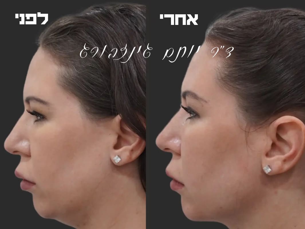סנטר כפול לפני ואחרי | ד״ר גינזבורג