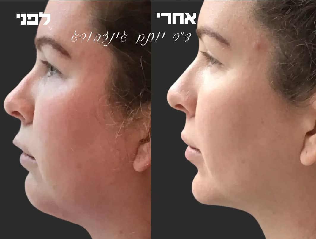 המסת שומן צווארי לפני ואחרי | ד״ר גינזבורג